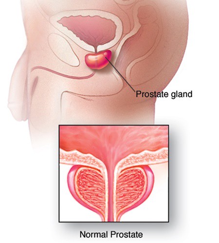 Cirugía para el chancer de próstata