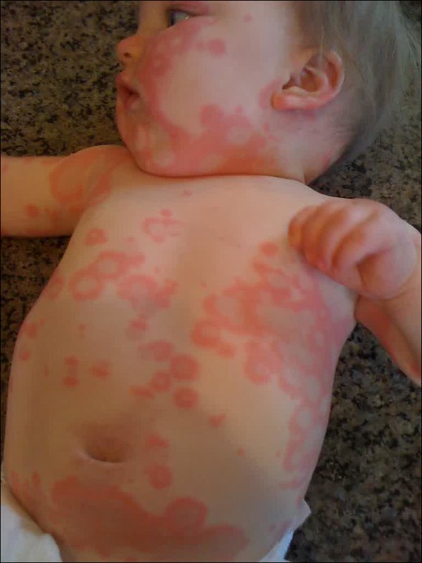 Can Food Allergies Trigger Baby Eczema Rashes?