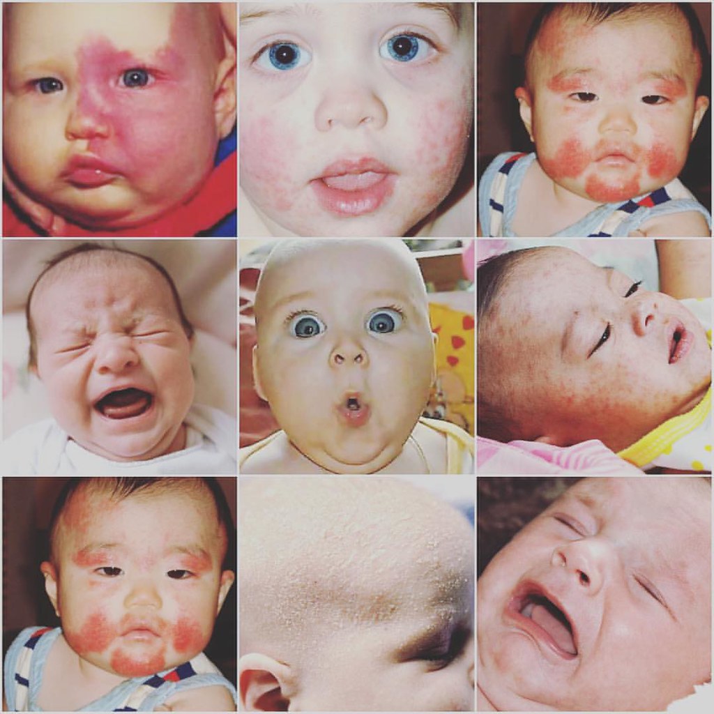 Flickr Bebe Rash What’s causing your BABY RASH?? ఆరోగ్యమే మహాభాగ్యము.మనిషిక… | Flickr