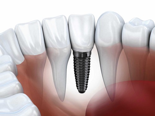 Beautify Your Smile With Dental Implants San Diego CA