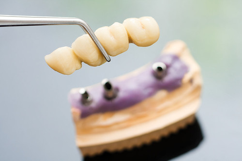 Dental implant | by upc.odontologia