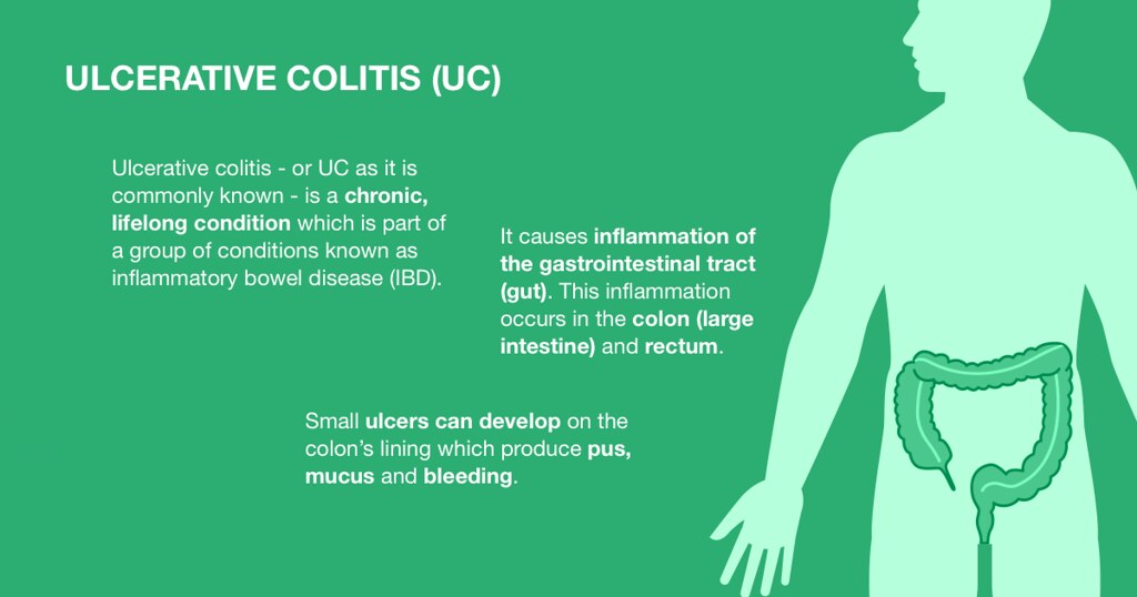 Ulcerative colitis (UC)