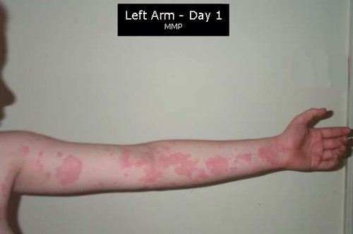 Left Arm - Day 1
