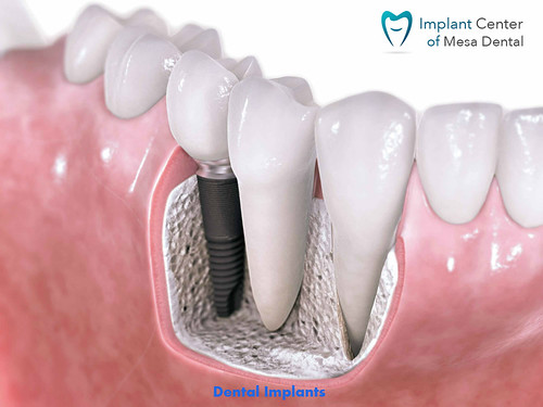 Get Beautiful Teeth at Nominal Dental Implant Cost San Diego