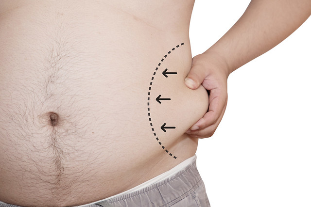 Complete Guide to Liposuction in Singapore - Ubiqi Health