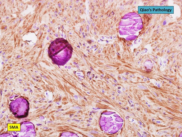 Qiao's Pathology: Digital Leiomyoma with Numerous Psammoma Calcifications