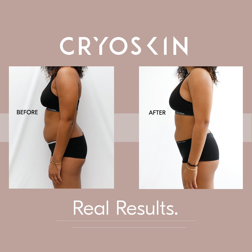 Cryoslimming cryo slimming pics | Meco Choates | Flickr
