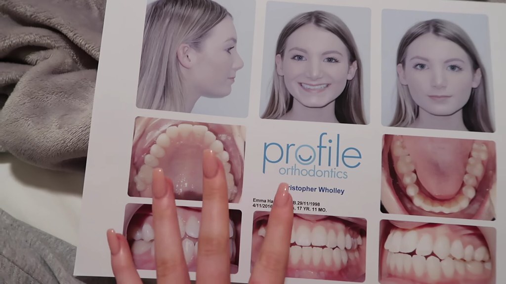 Blonde Teeny Braces Teeth | Flickr