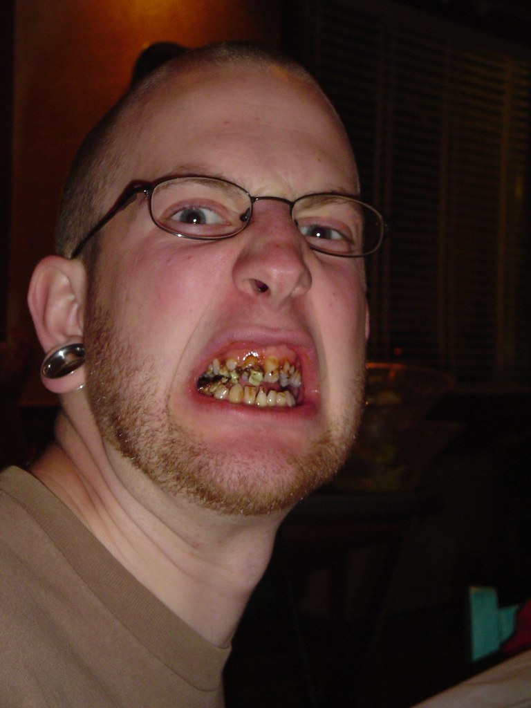 GRAPHIC* Devin Clark's teeth.