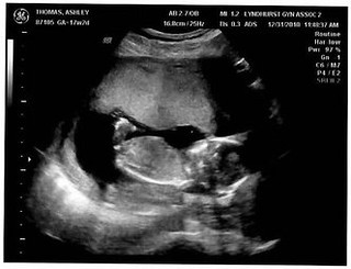15 Week Ultrasound - 2 | His first appearance on New Years E… | Flickr