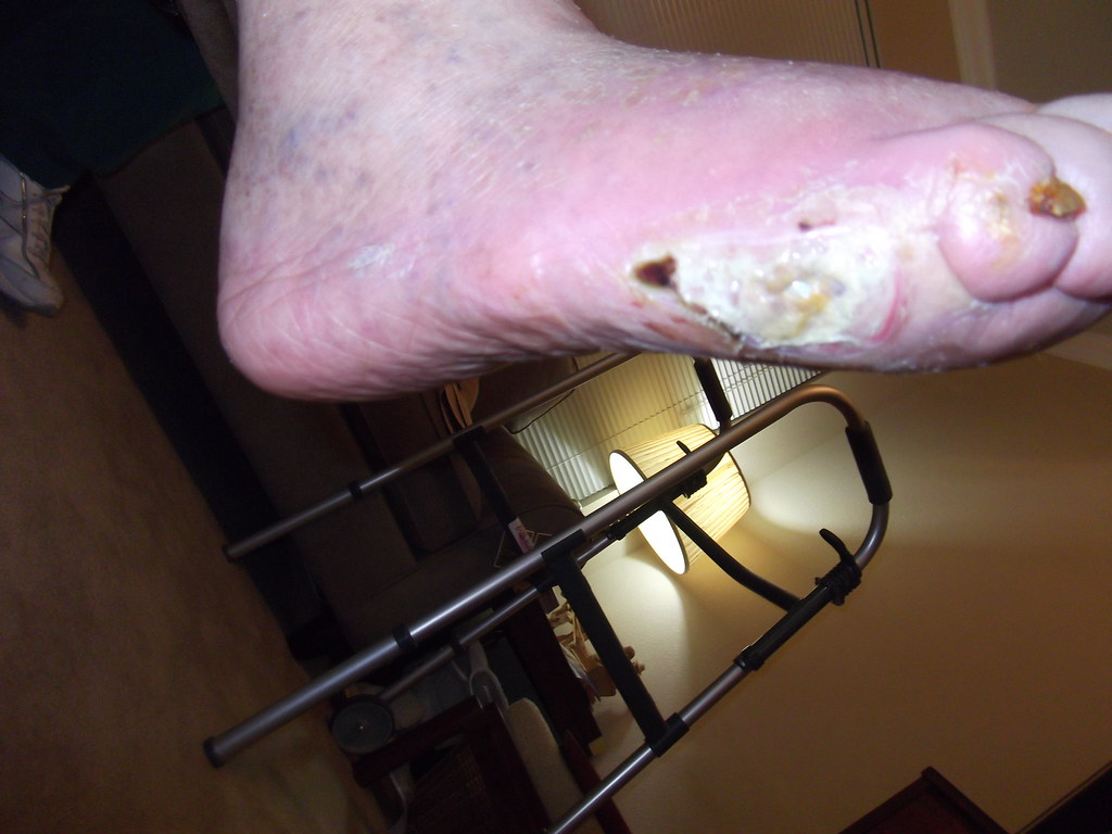Medical History: Chronic Diabetic foot ulcer, Right Great … | Flickr