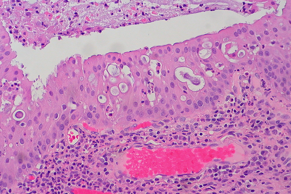 oncocytic papilloma sinus giardia es zoonosis