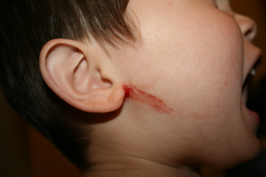 eczema on ear | brandon has been scratching his ear a lot la… | flickr