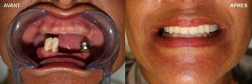 Bridge sur implant | by Smile Partner Gallery