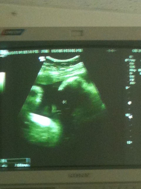 Ultrasound @ 39 weeks