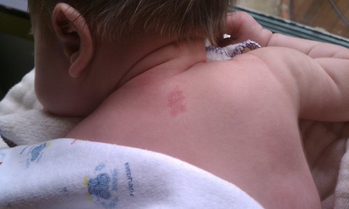 Bailey R Birthmark The birthmark | Garlynn | Flickr