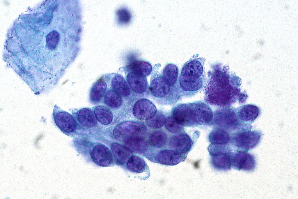 Adenocarcinoma in Situ of the Cervix