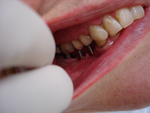 Implantes | by Clinica Ede
