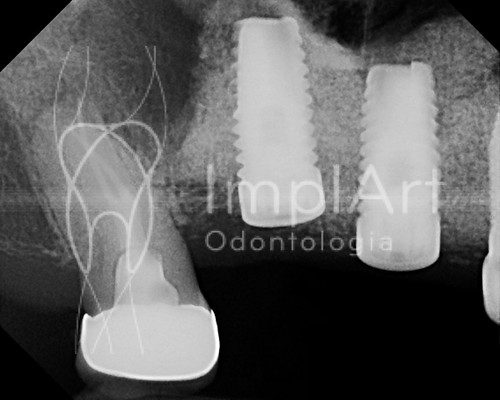 implantes instalados em região de enxerto ósseo | by Implart