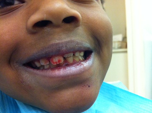 Oops  - Dislocated Tooth