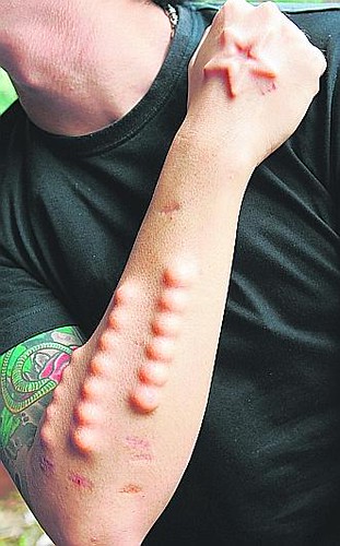 dermal-implants_1 | by closetjezebel