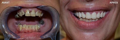 Bridge sur implant | by Smile Partner Gallery