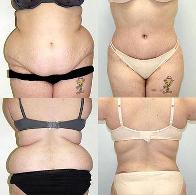 Abdominoplasty | by Jennifer Stone1