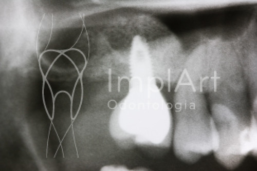 implante inserido em seio maxilar com enxerto - radiografia | by Implart
