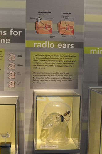 cochlear implant yipiii! | by dozodozo