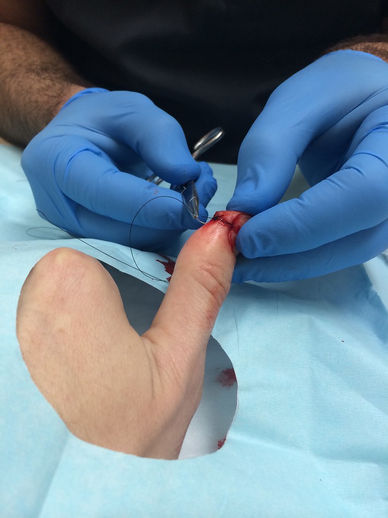 Frankenthumb