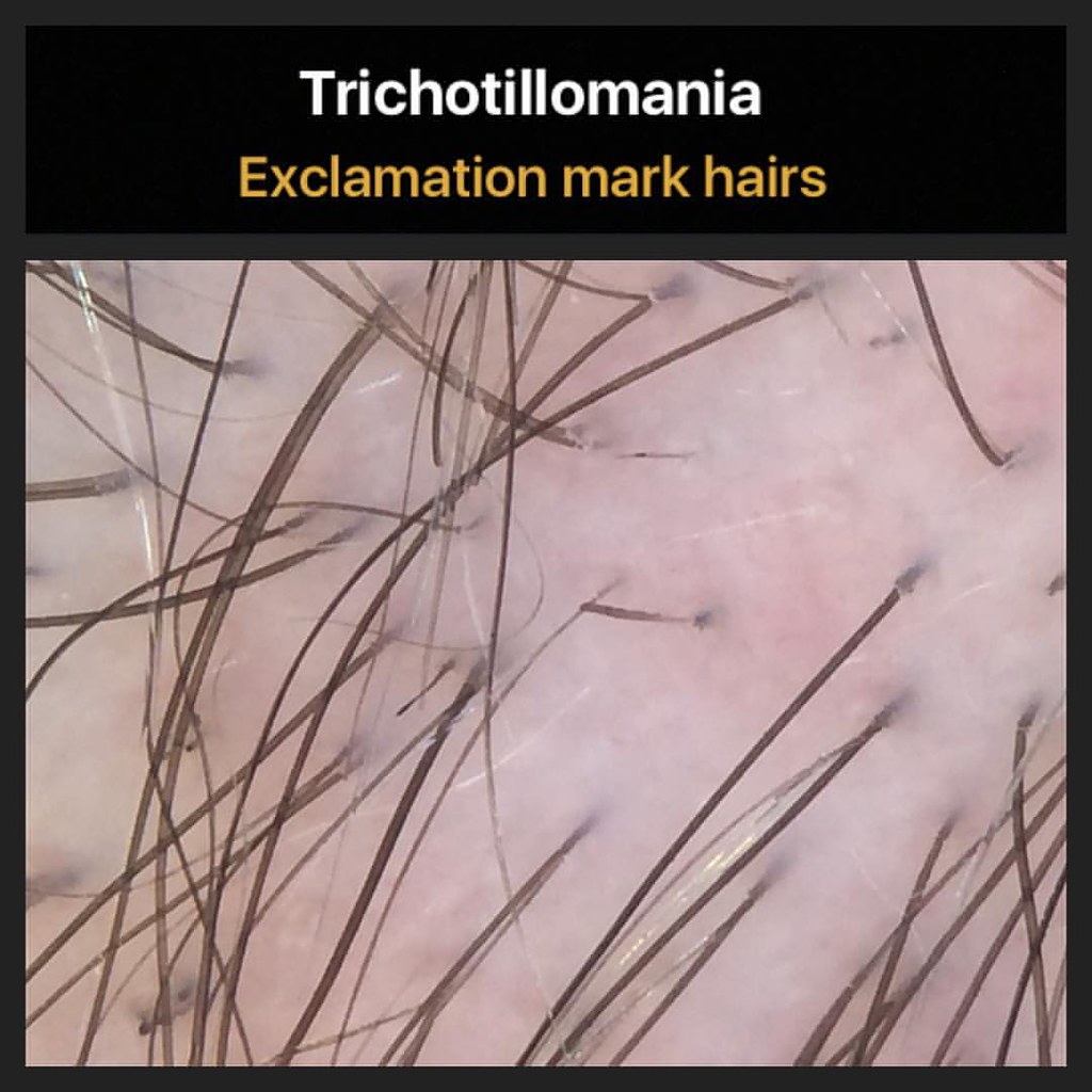 Exclamation mark hairs are short hairs that are commonly s… | Flickr