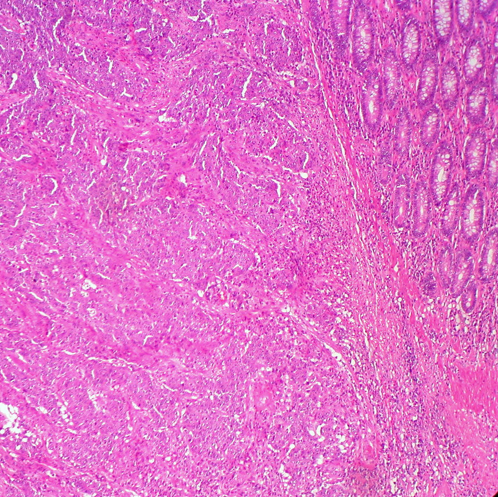 Medullary Carcinoma of the Colon, H&E
