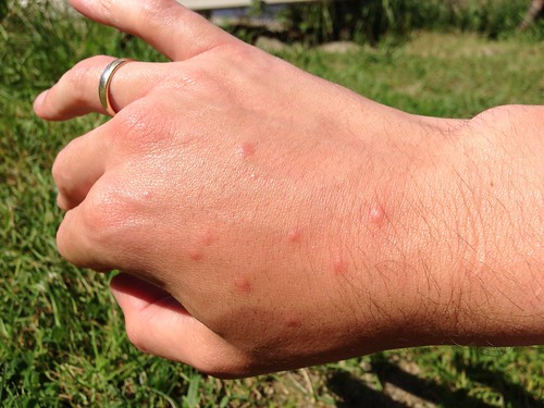 Mosquito bites