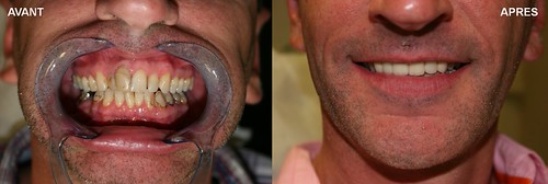 Bridge sur implant | by Smile Partner Gallery