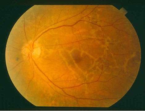 Illustration 35. Example of a Guam Retinal Pigment Epitheliopathy (GRPE), with the white tracks of depigmentation (from the wandering of an assumed larva). Photo from John C. Steele. Courtesy of Dr. Verena Keck, from her book The Search for the Cause, 2011.