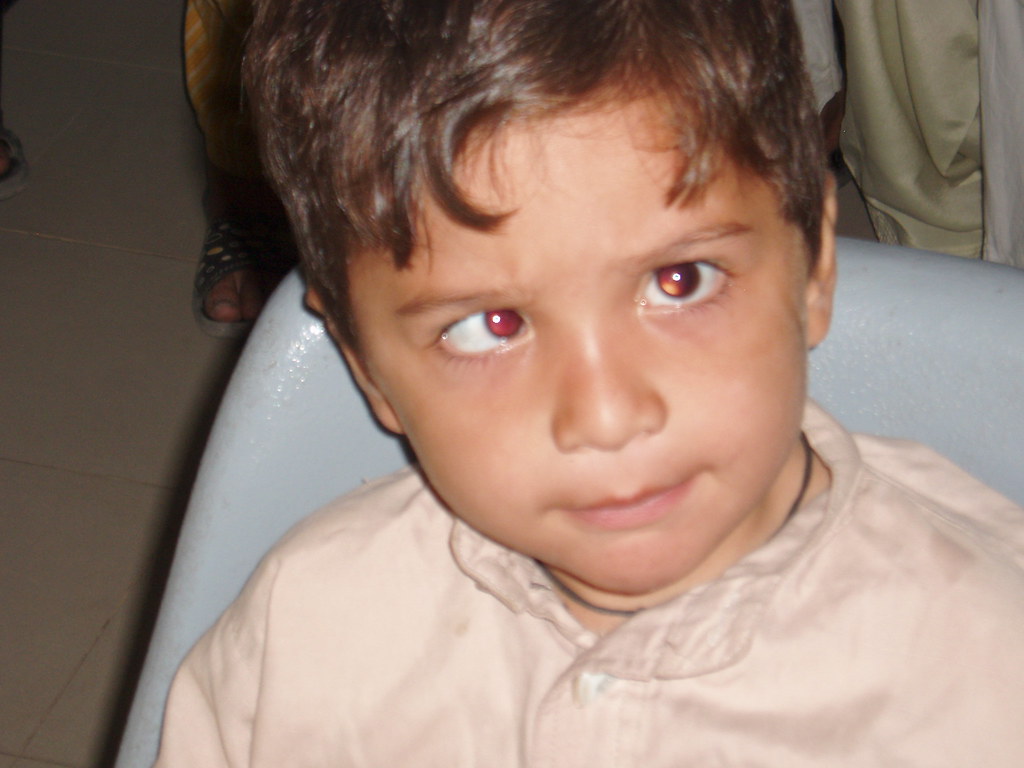 #StrongerTogether child with eye disease | Submitted by ...