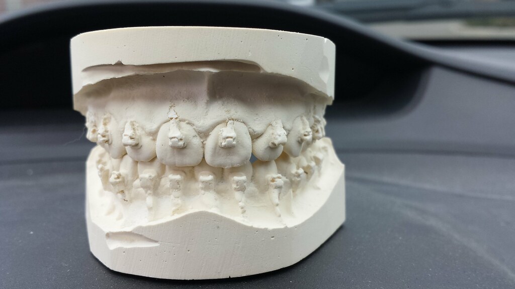 Cast for retainer. Just before braces removed.