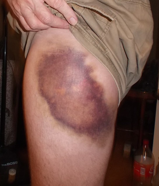 Big Bruise