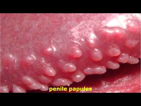 Penile papules white White Spots