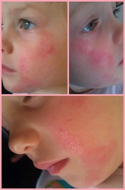Infant face rash, allergic reaction to methylisothiazolinone - a photo ... Makeup Allergic Reaction