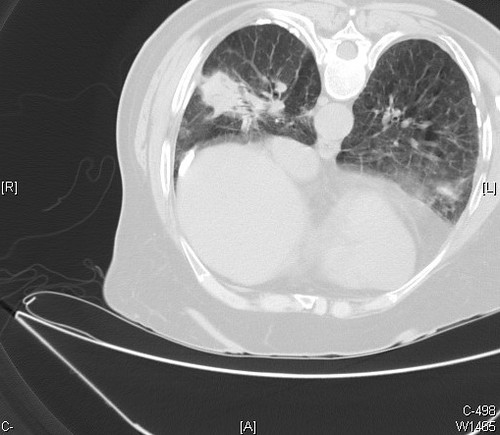 Asbestosis and cryptococcosis - Pleural plaques - CT scan  Case 194