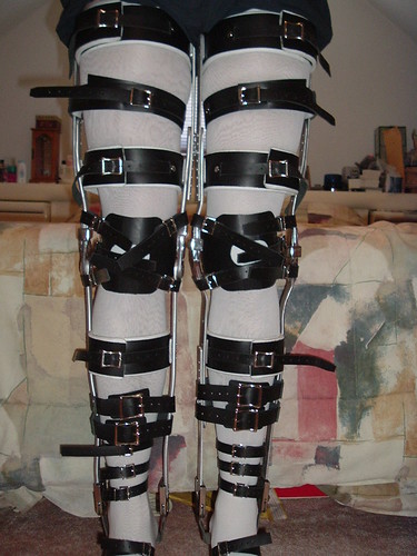 Model Standing in Her Brace Sandals and Leg Braces | by KAFOmaker