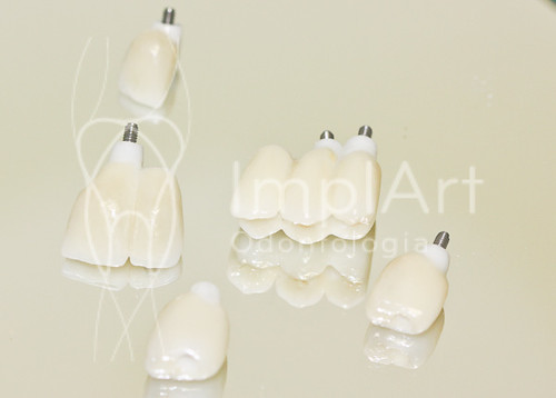 CAD CAM - Coroas em zircônia sobre implantes dentários 2 | by Implart