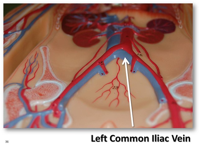 Left Common Iliac Vein The Anatomy Of The Veins Visual Guide Page 36