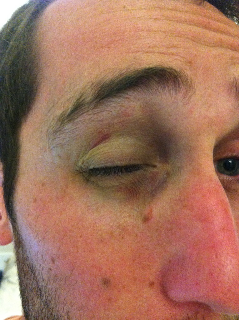 Black Eye