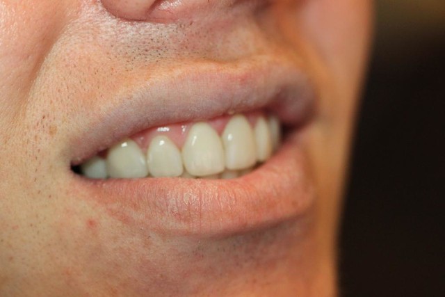 This natural smile is 12 units of veneers on all the upper teeth!