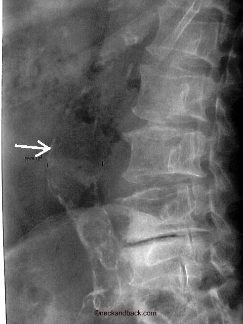 Abdominal Aortic Aneurysm Xray