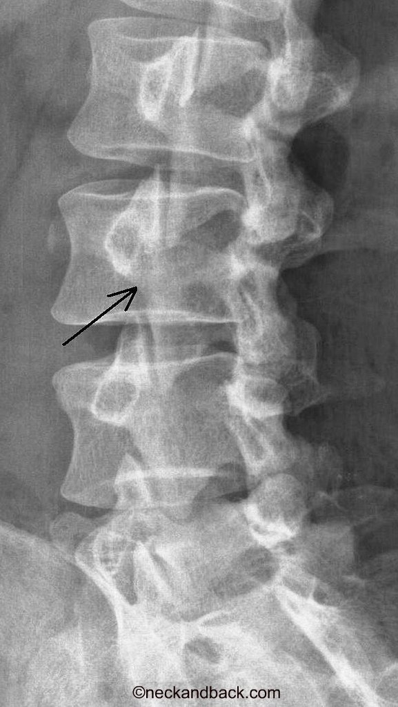 Pars Fracture of the Spine | Spondylolysis | Orthopedic Sp… | Flickr