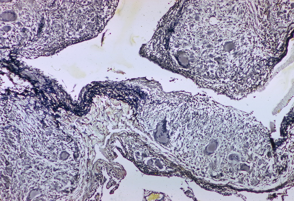 Sarcoidosis - Granulomatous phlebitis - Elastic tissue stain