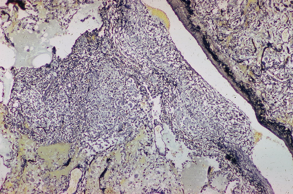 Sarcoidosis - Granulomatous phlebitis - Elastic tissue stain